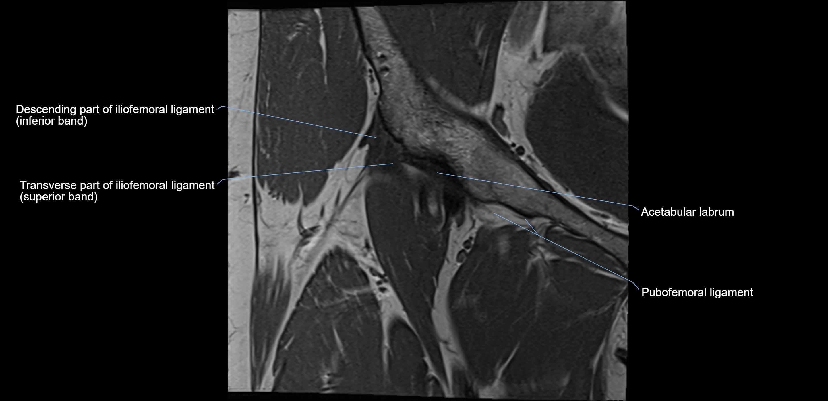 MRI Hip ligaments coronal cross sectional anatomy 3T  radiology  image-img-00001-00003.webp